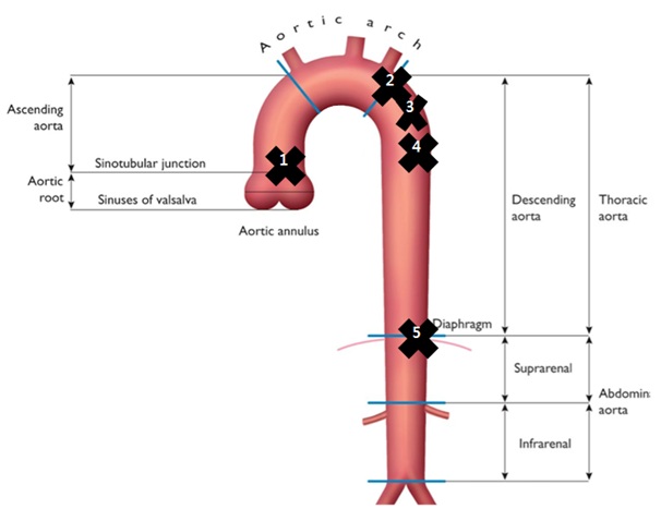 Collateral Flows In Patients With Aortic Coarctation A Clinical And